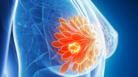 cancro al seno