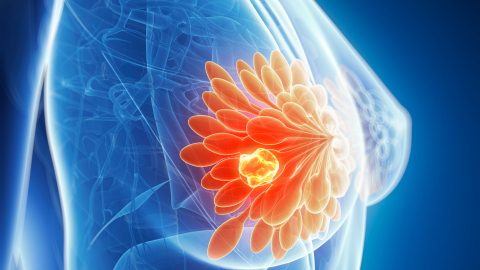 cancro al seno
